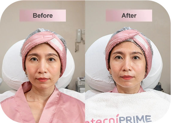 Botox Prime - Eterniskin