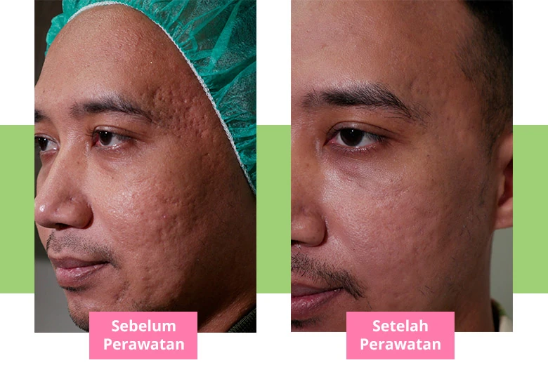 Before After Laser PicoSure Pro Bopeng