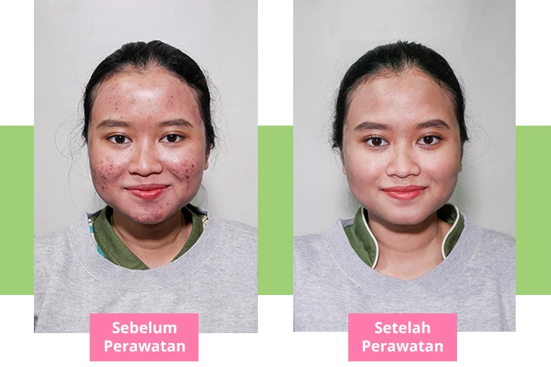 Before After Laser PicoSure Pro Hiperpigmentasi