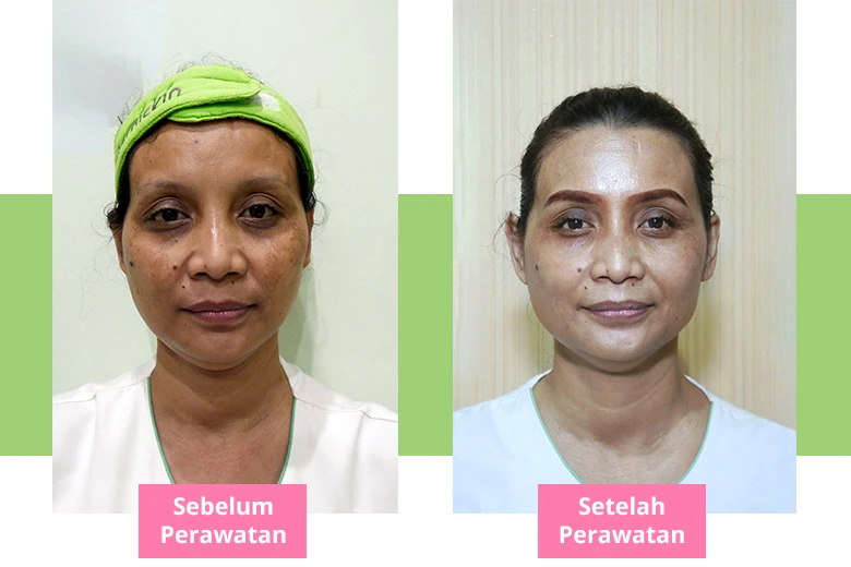 Before After Laser PicoSure Pro Melasma