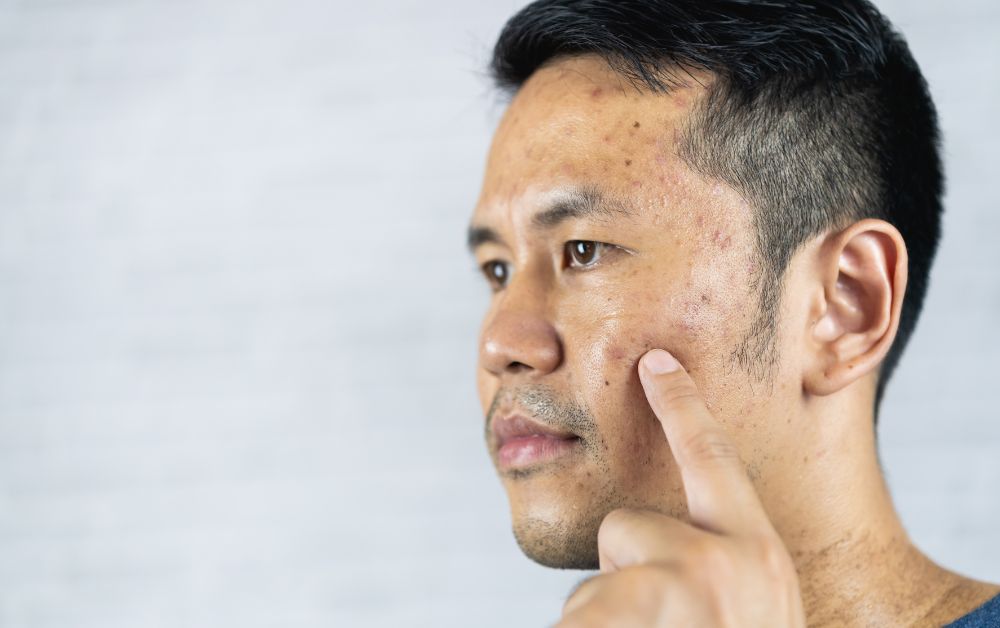 Kenapa Bekas Jerawat Membandel Kadang Memerlukan Laser Pico?