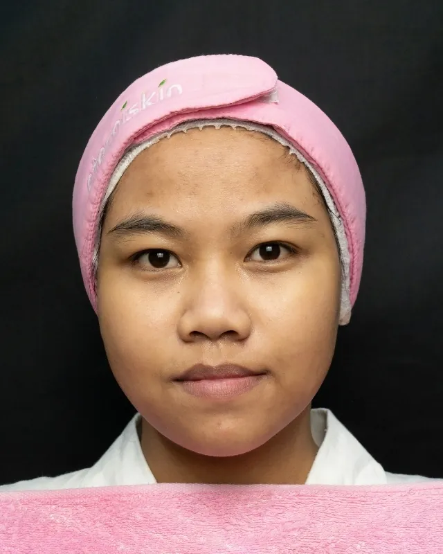 eterniskin-breakout-clear-facial-after