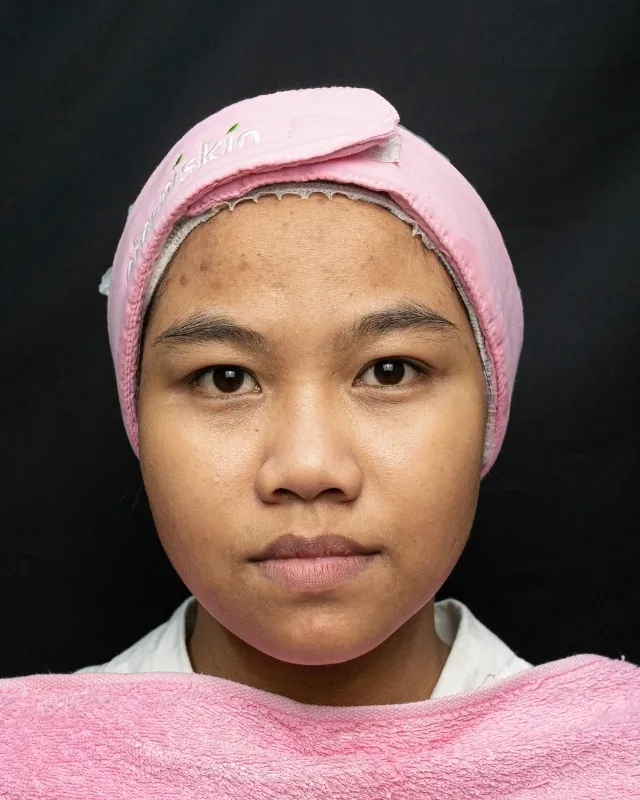 eterniskin-breakout-clear-facial-before