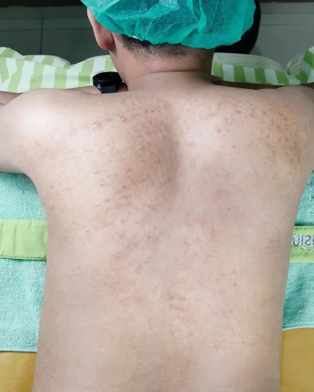eterniskin-eterni-glow-peel-body-before
