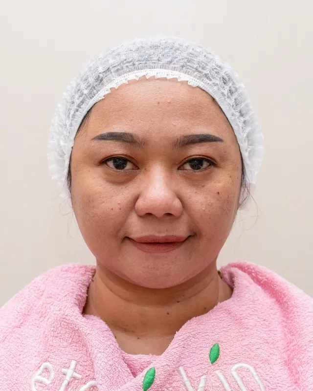 eterniskin-eterni-lhala-korean-glass-peel-before