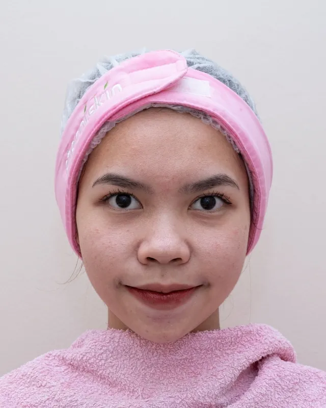 eterniskin-facial-eterni-dermapro-before