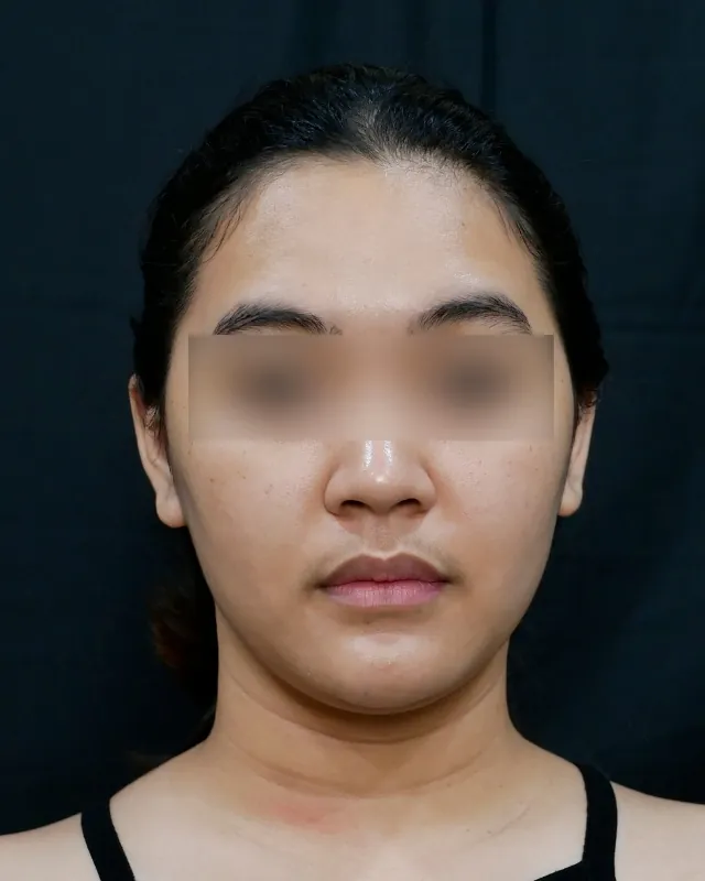 eterniskin-facial-eterni-detox-after