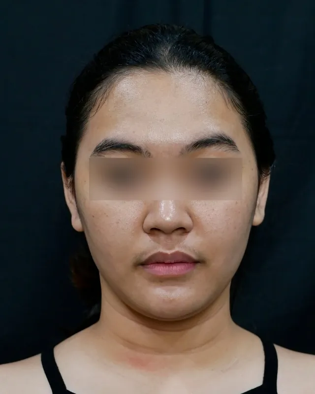 eterniskin-facial-eterni-detox-before