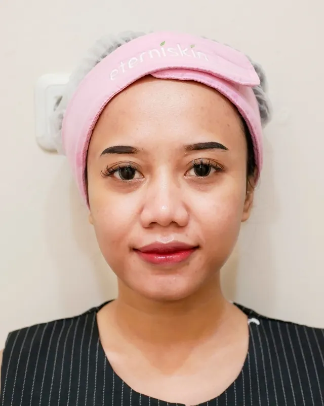 eterniskin-facial-eterni-light-plus-after