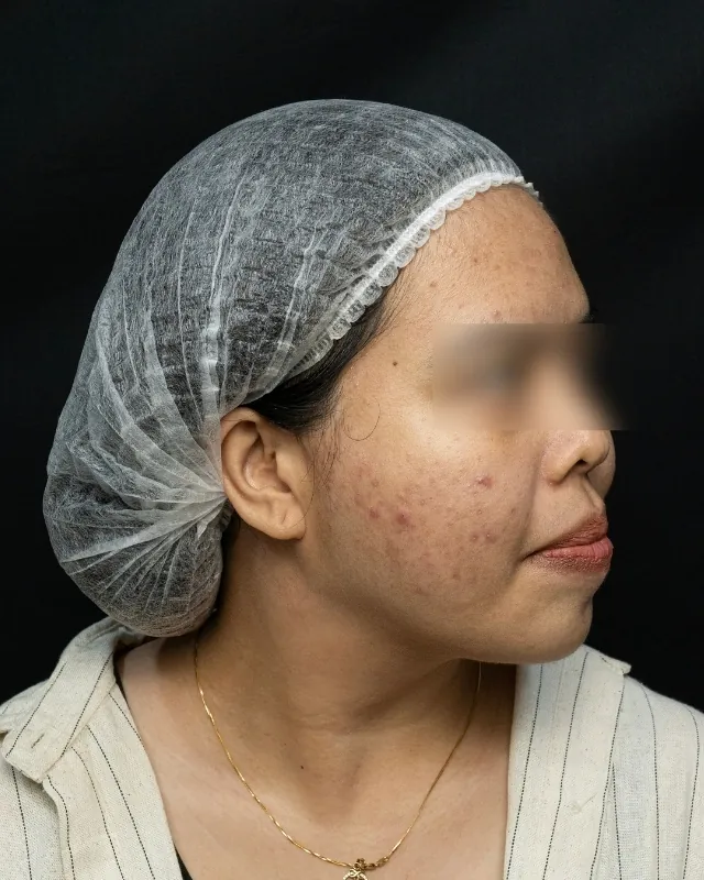 eterniskin-facial-eterni-oxy-before