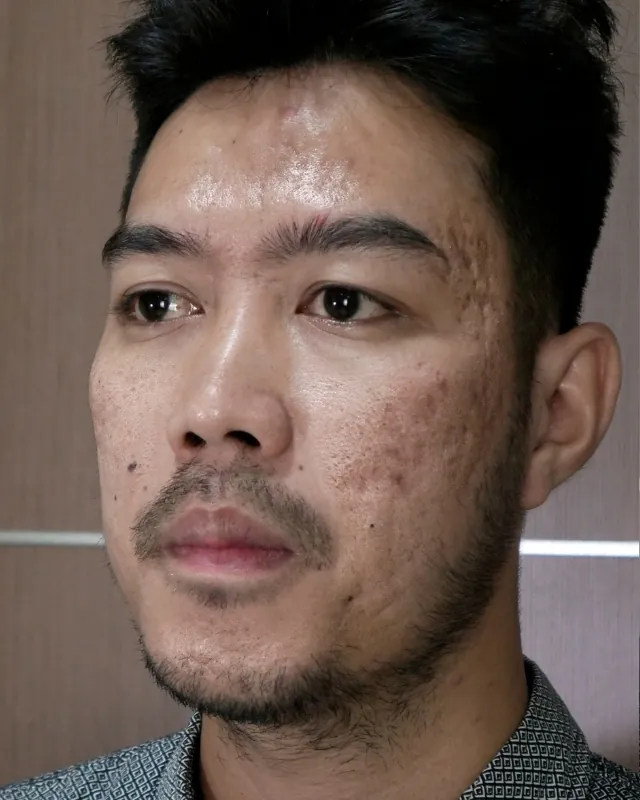 eterniskin-laser-fractionil-before