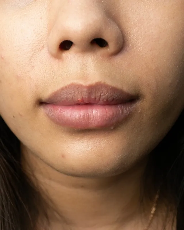 eterniskin-pico-lip-laser-after