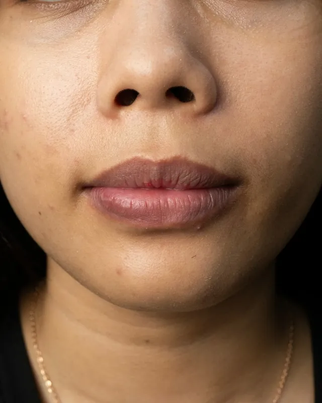 eterniskin-pico-lip-laser-before