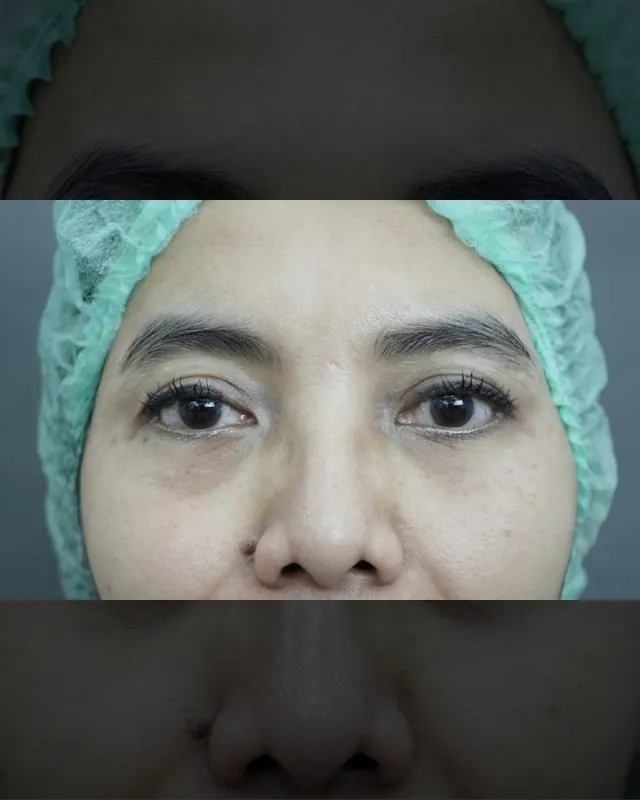 eterniskin-revital-eye-injection-after