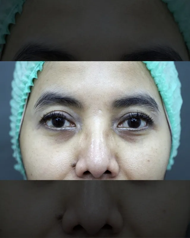 eterniskin-revital-eye-injection-before