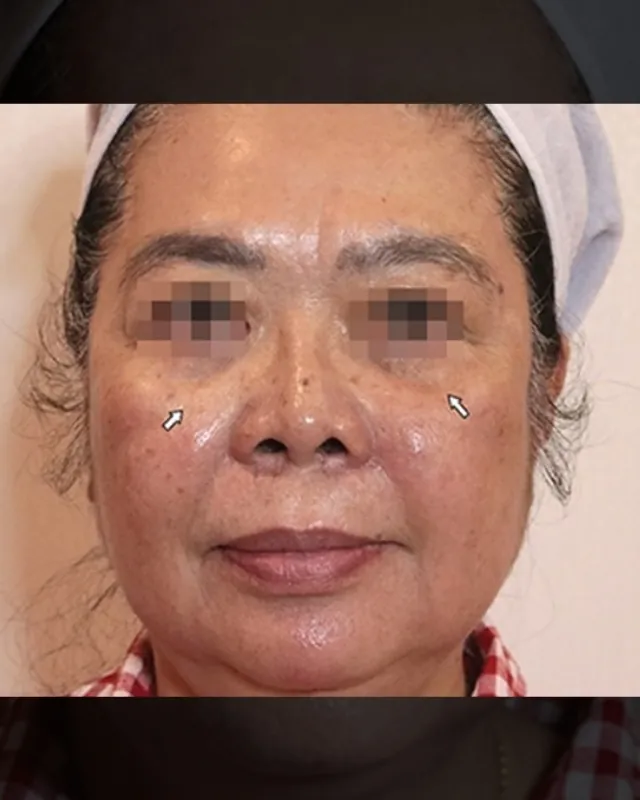 eterniskin-revital-face-injection-after