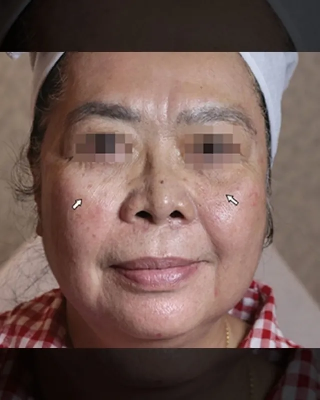 eterniskin-revital-face-injection-before