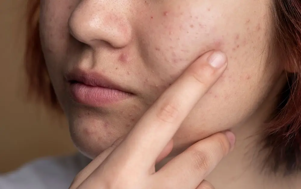 Skin Booster DNA Salmon: Manfaat untuk Peremajaan & Tekstur Kulit