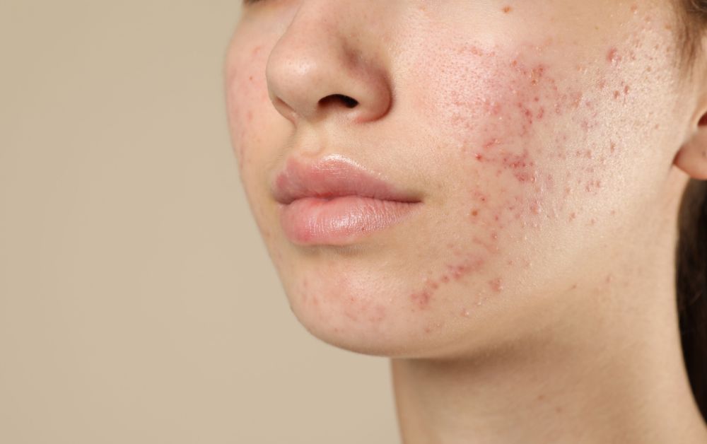 Skin Booster Untuk Bekas Jerawat Halus: Realistis